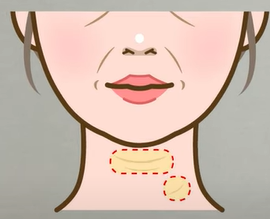 In Apgujeong plastic surgery, is revision lifting essential once the facelift maintenance period has passed? image 10