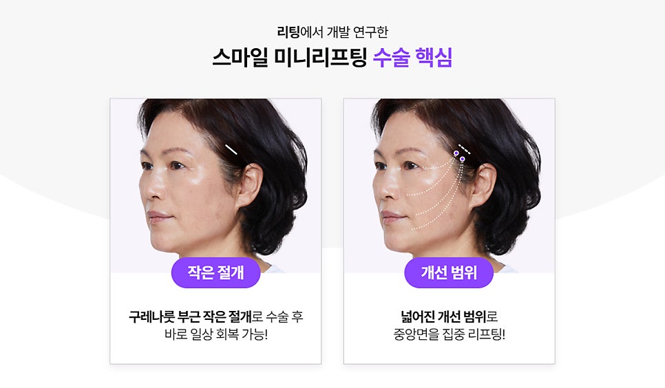 리팅성형외과 미니리프팅 궁금한 점 알려드립니다 관련 이미지 6