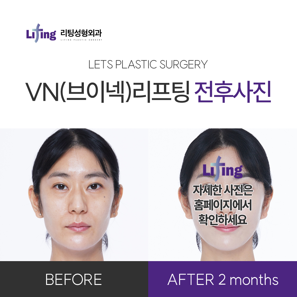 If You’re Worried About Facelift Side Effects image 5