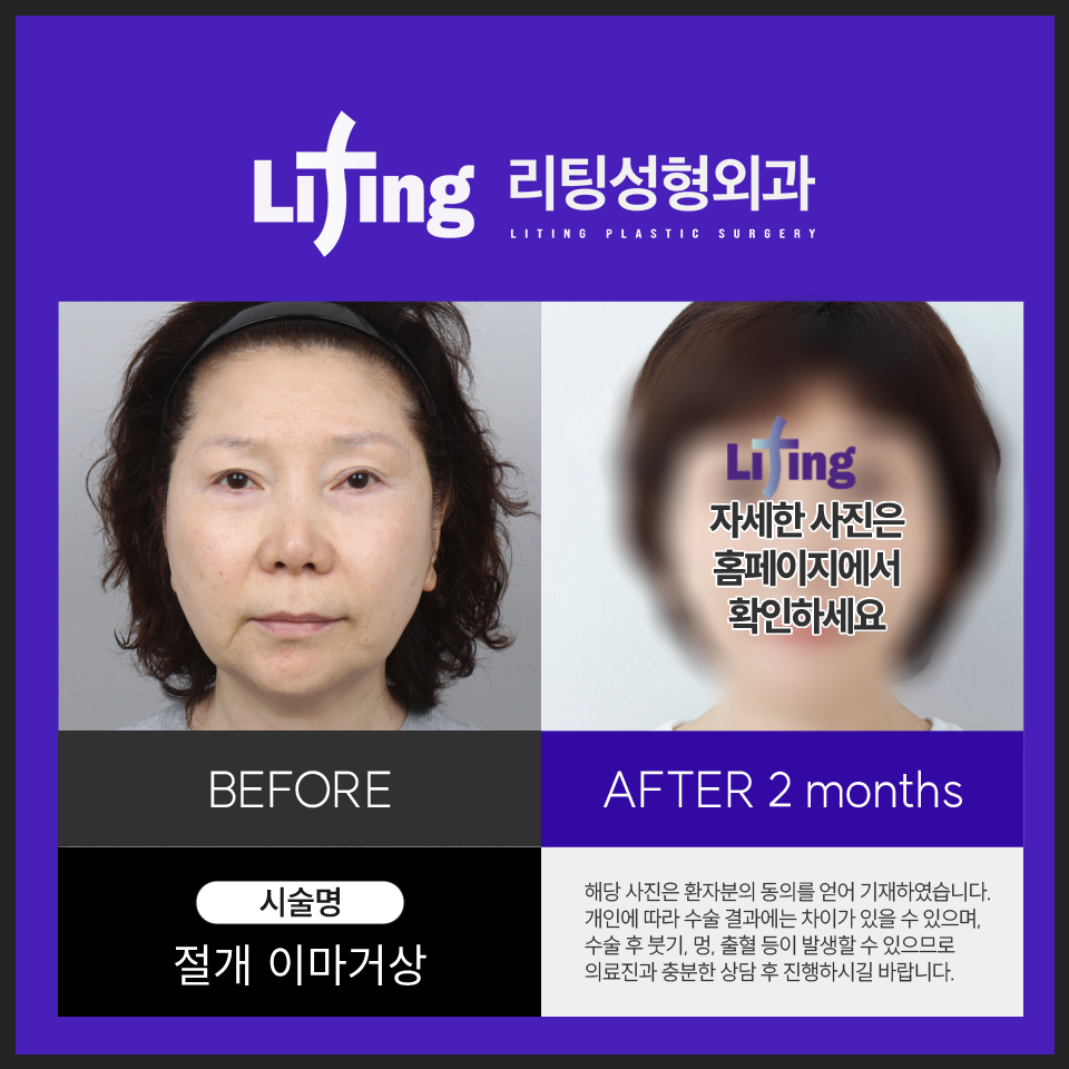 You may regret proceeding based only on the price of a brow lift image 10