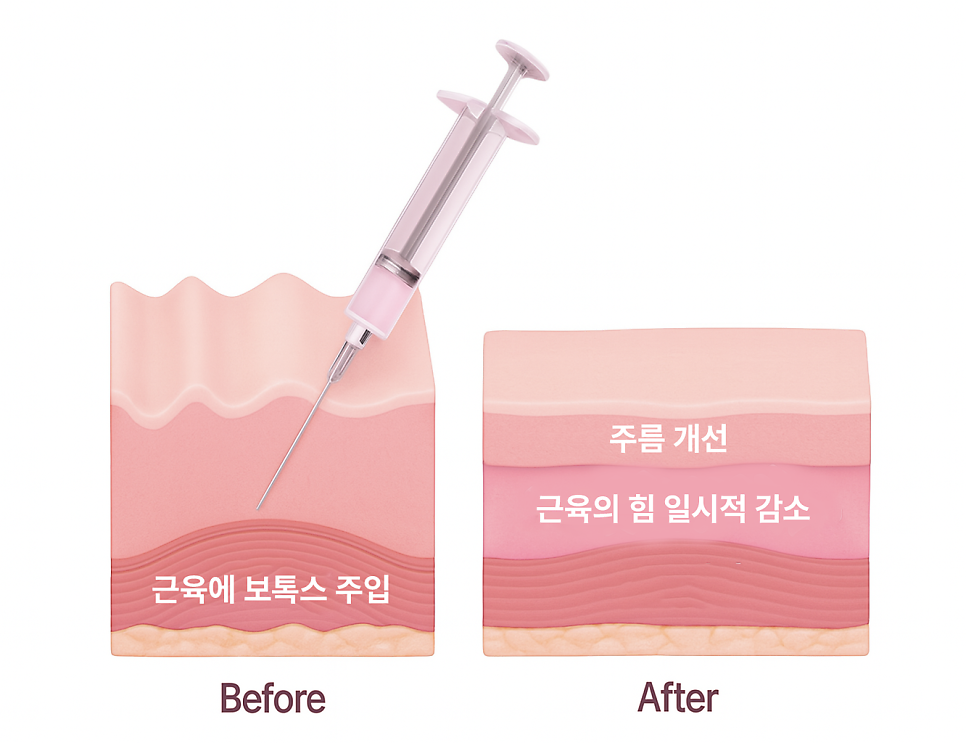 얼굴실리프팅 목주름보톡스, 목주름 솔루션 여름이 타이밍! 관련 이미지 4