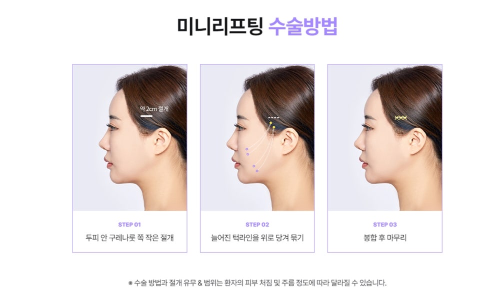 `리팅성형외과가 말하는 미니리프팅 핵심은 관련 이미지 3
