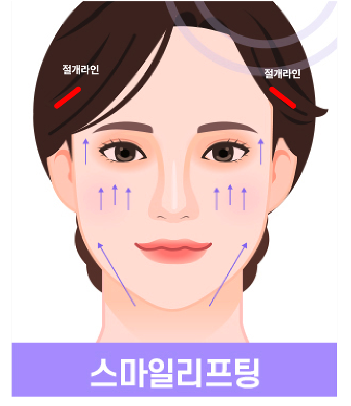 Mini Facelift, Gangnam Facelift: 3 Features That Create a Youthful Effect image 12