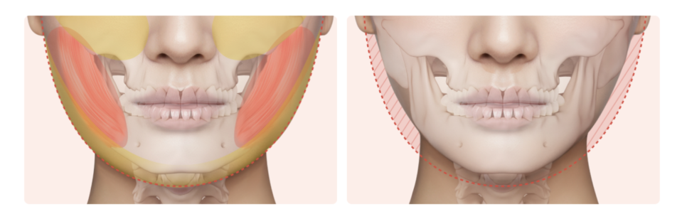 Sinsa Station Lifting Plastic Surgery Clinic Mini Contouring: How to Refine Facial Lines Without Bone Reduction | Liting Plastic Surgery Seoul Branch image 3