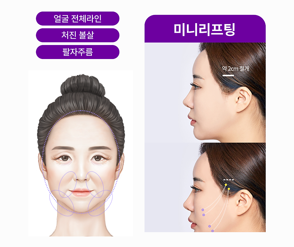 Mini Facelift, Gangnam Facelift: 3 Features That Create a Youthful Effect image 7