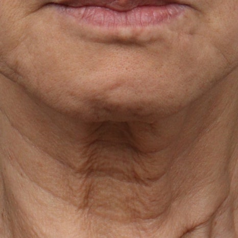 If you’re 고민ed about neck wrinkle procedures or neck wrinkle surgery, start with the wrinkle type at 리팅성형외과 image 2