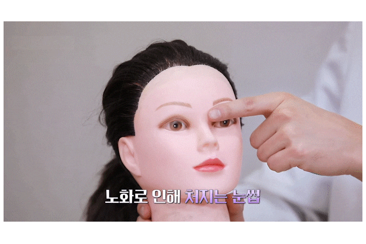 Why Forehead Thread Lifting and Drooping Eyelid Lifting Should Be Considered Together image 5