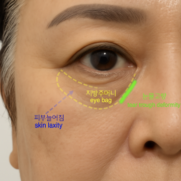 신사리프팅성형외과 눈밑지방재배치수술비용 궁금하다면? 하안검 수술과 비교해보세요 관련 이미지 4