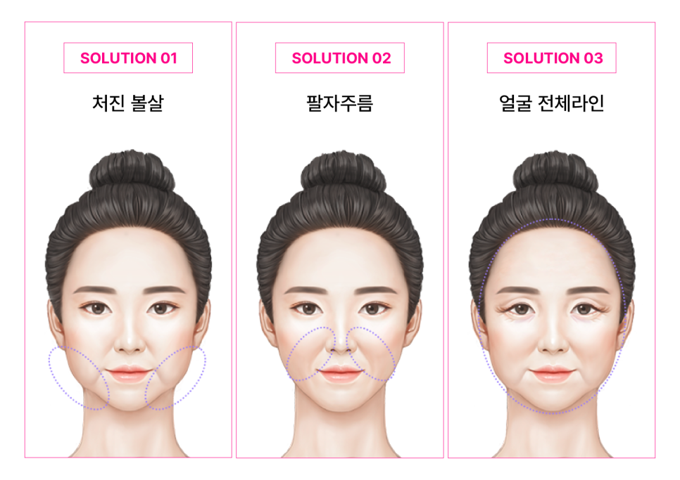 하안부는 왜 먼저 무너질까 청담미니리프팅과 브이라인리프팅의 구조적 접근 관련 이미지 6