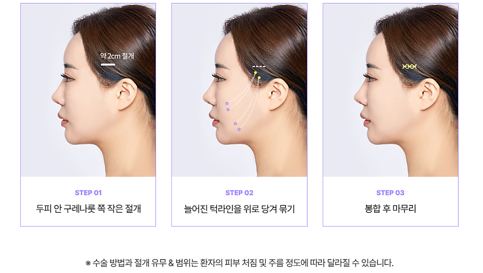 미니안면거상술, 안 하면 후회하는 이유?! 관련 이미지 4
