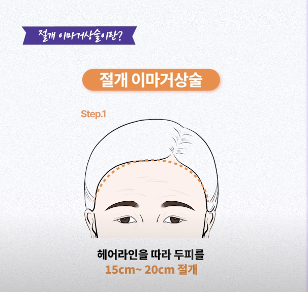 Songpa Plastic Surgery Forehead Wrinkle Botox: The Real Reason It Didn’t Work for Me image 12