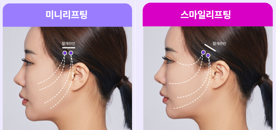 Shinsa Mini Lift, Lifting Plastic Surgery Clinic: Clear Answers to Frequently Asked Questions About Smile Lifting! image 2