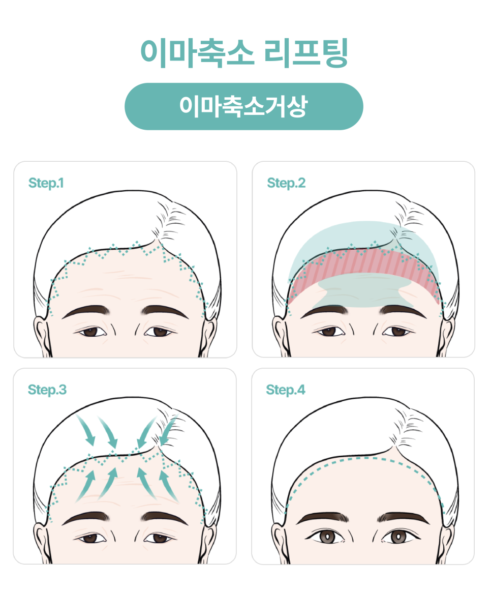 신사이마리프팅으로 달라지는 동안 한끗, 리프팅성형외과 전문의가 밝히는 결정적 차이 관련 이미지 13