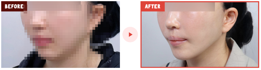 뼈 절제 없이 얼굴선 정돈, 안면윤곽수술의 또 다른 해석 | 리팅미니윤곽술 관련 이미지 9