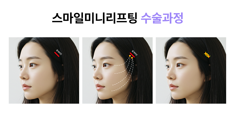 스마일미니리프팅, 압구정리프팅성형외과가 알려주는 인기많은 리프팅 최신 트렌드 관련 이미지 7