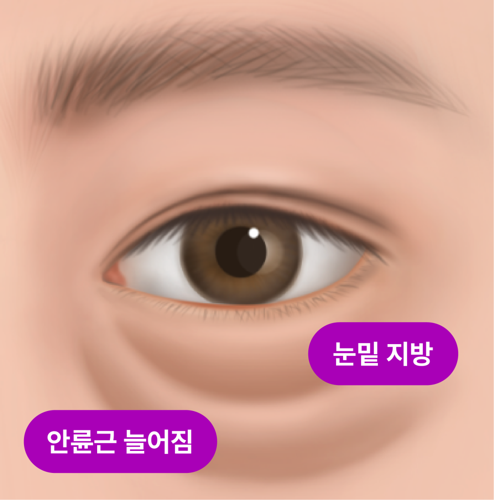 Understanding Gangnam Under-Eye Fat Repositioning, Causes of Hollow Under Eyes, and How the Structure Around the Eyes Changes with Age image 15