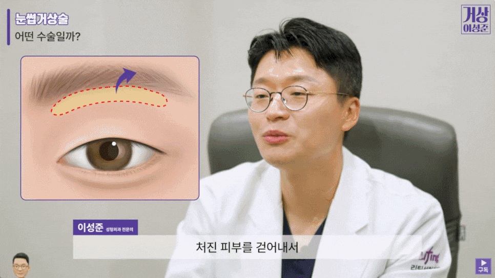 Midlife Brow Lift Review: The Reason Your Expression Looks Droopy Can Be Improved image 8