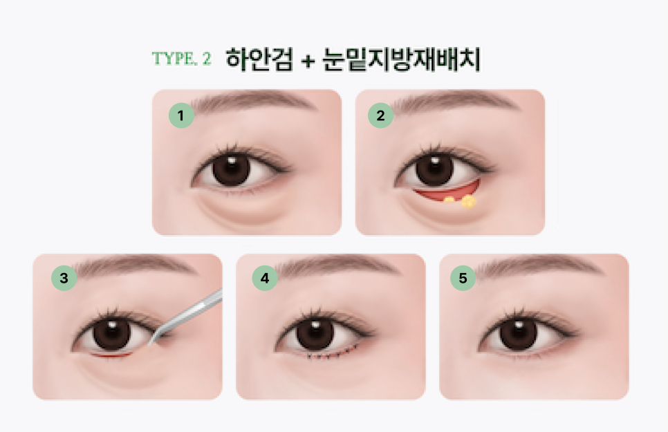 Understanding Gangnam Under-Eye Fat Repositioning, Causes of Hollow Under Eyes, and How the Structure Around the Eyes Changes with Age image 14