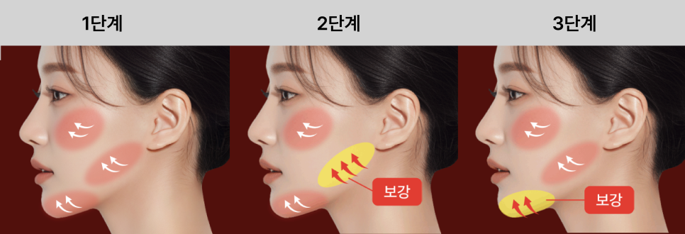 안면윤곽수술 뼈를 깎지 않고 윤곽선을 다듬는 신사윤곽성형외과 관련 이미지 13