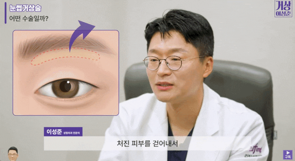 눈꺼풀처짐리프팅으로 또렷한 눈매를 되찾고 싶다면? 관련 이미지 3