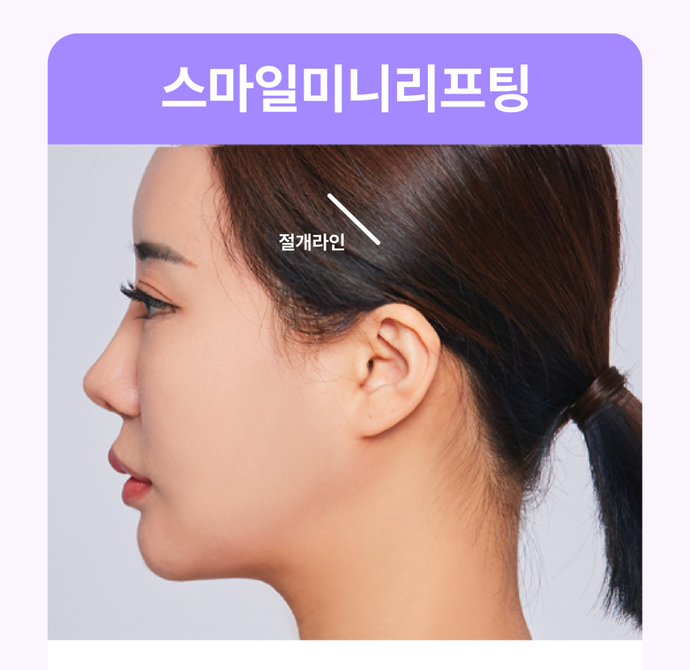 Smile Lifting Review and the Latest Lifting Trends Noted by Gangnam Lifting Dermatology Clinics image 6