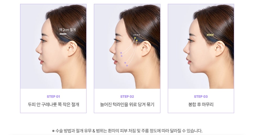 Why You Shouldn’t Proceed Based on Mini Facelift Price Alone <Written by a Current Plastic Surgeon> image 4
