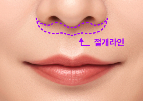 인중축소술의 새로운 접근, 리팅인중축소술 나만의 동안 비율로 조화롭게 디자인하다 관련 이미지 8