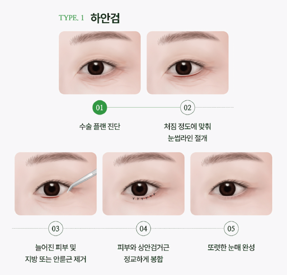 Sinsa Under-Eye Fat Repositioning: A Guide to Natural Under-Eye Changes from a Sinsa Lifting Dermatology Clinic image 3