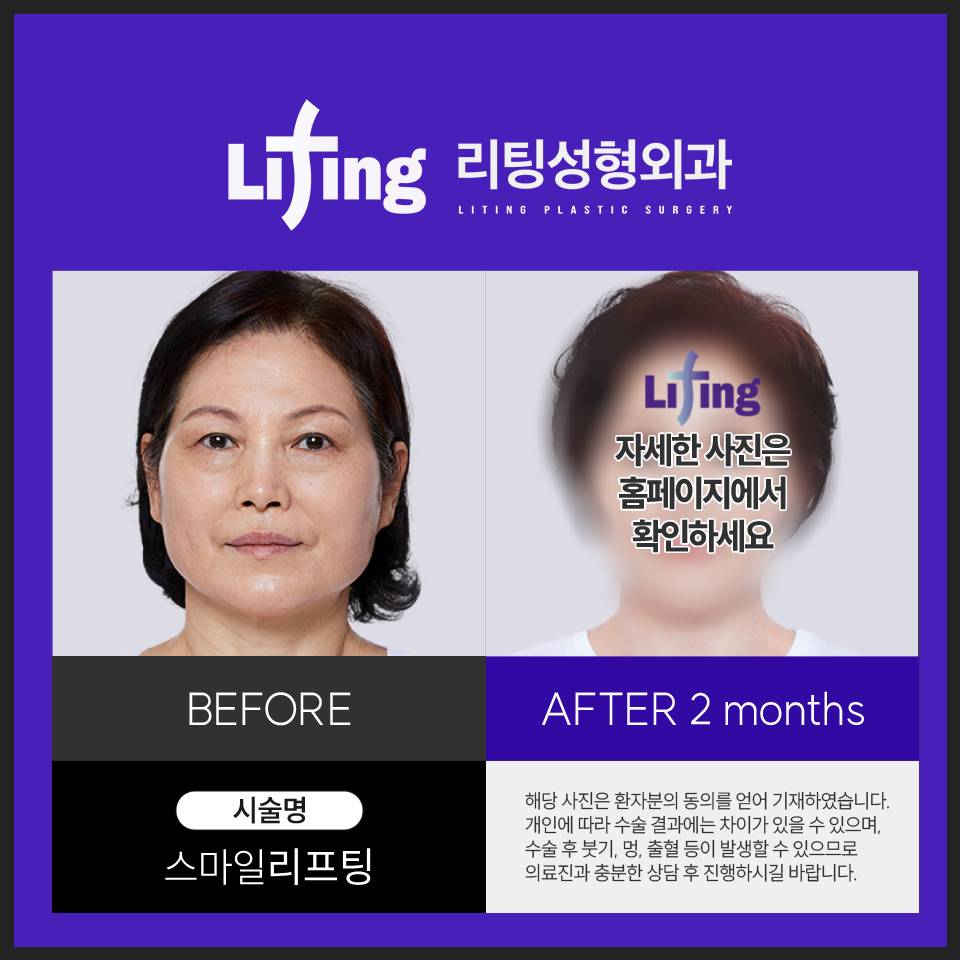 60대 안면거상후기 만족스러운 결과물을 얻기 위해서는? 관련 이미지 5