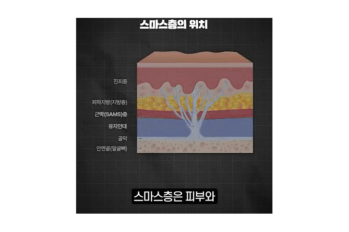 Smiley Lift, How to Improve Midface Sagging While Reducing Incision 부담｜Sinsa Lifting Plastic Surgery Clinic image 7