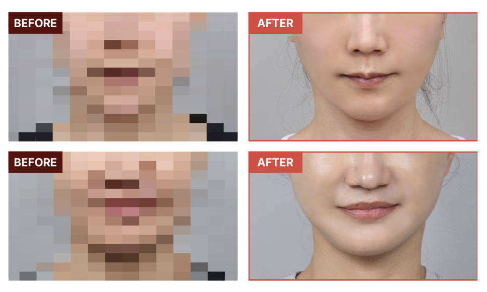 심부볼제거와 안면윤곽수술, 얼굴의 흐름을 디자인하는 리팅성형외과 서울점 또 다른 방법 관련 이미지 8