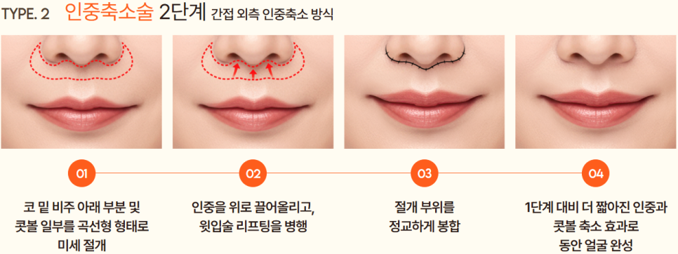 인중축소수술후기로 보는 얼굴 중심 비율의 재조정 ｜ 신사리프팅성형외과의 섬세한 접근 관련 이미지 9