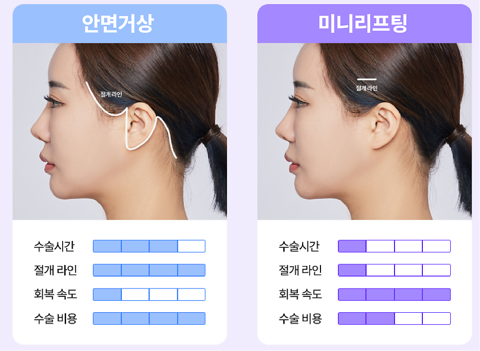 Smile Lift: The Effects and Differences Compared with Mini Lifting, as Seen at a Songpa Plastic Surgery Clinic image 2