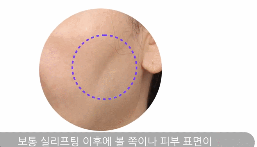 Thread Lift Dimpling? image 3