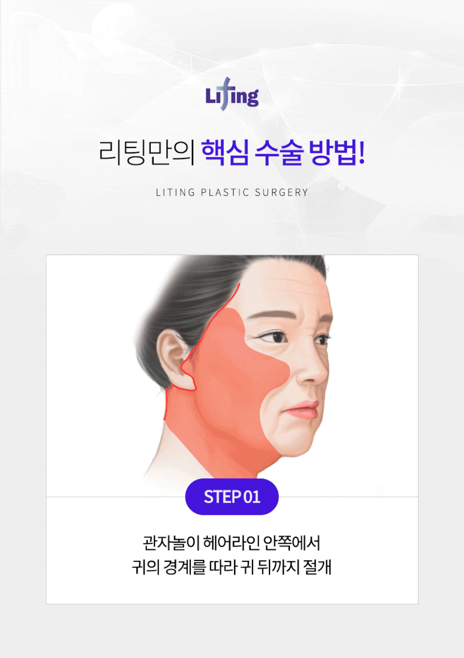 50대 안면거상 왜 지금이 가장 효과가 좋은 시기인지 알려드립니다 관련 이미지 3