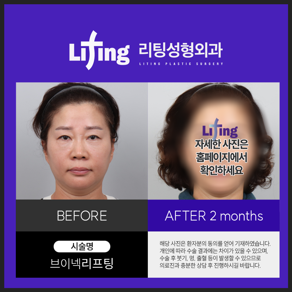 If you are looking into neck wrinkle surgery, check this out image 4