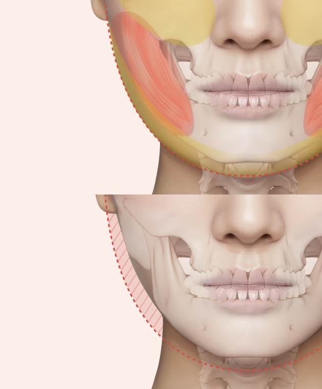 심부볼제거와 안면윤곽수술, 얼굴의 흐름을 디자인하는 리팅성형외과 서울점 또 다른 방법 관련 이미지 5