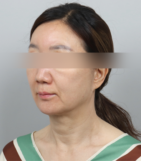 이중턱살없애는법? 리프팅 시술 10번 받아봤지만 효과 없었다면 이 글을 보세요 관련 이미지 6