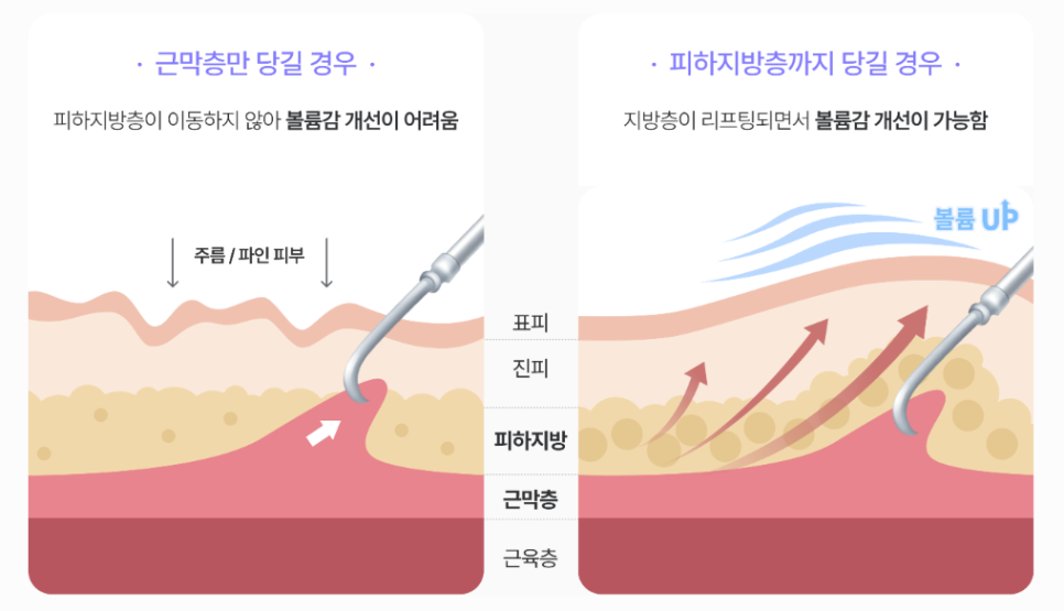 강남역성형외과 스마일거상 볼륨까지 살리는 반거상 리프팅의 핵심은? 관련 이미지 6