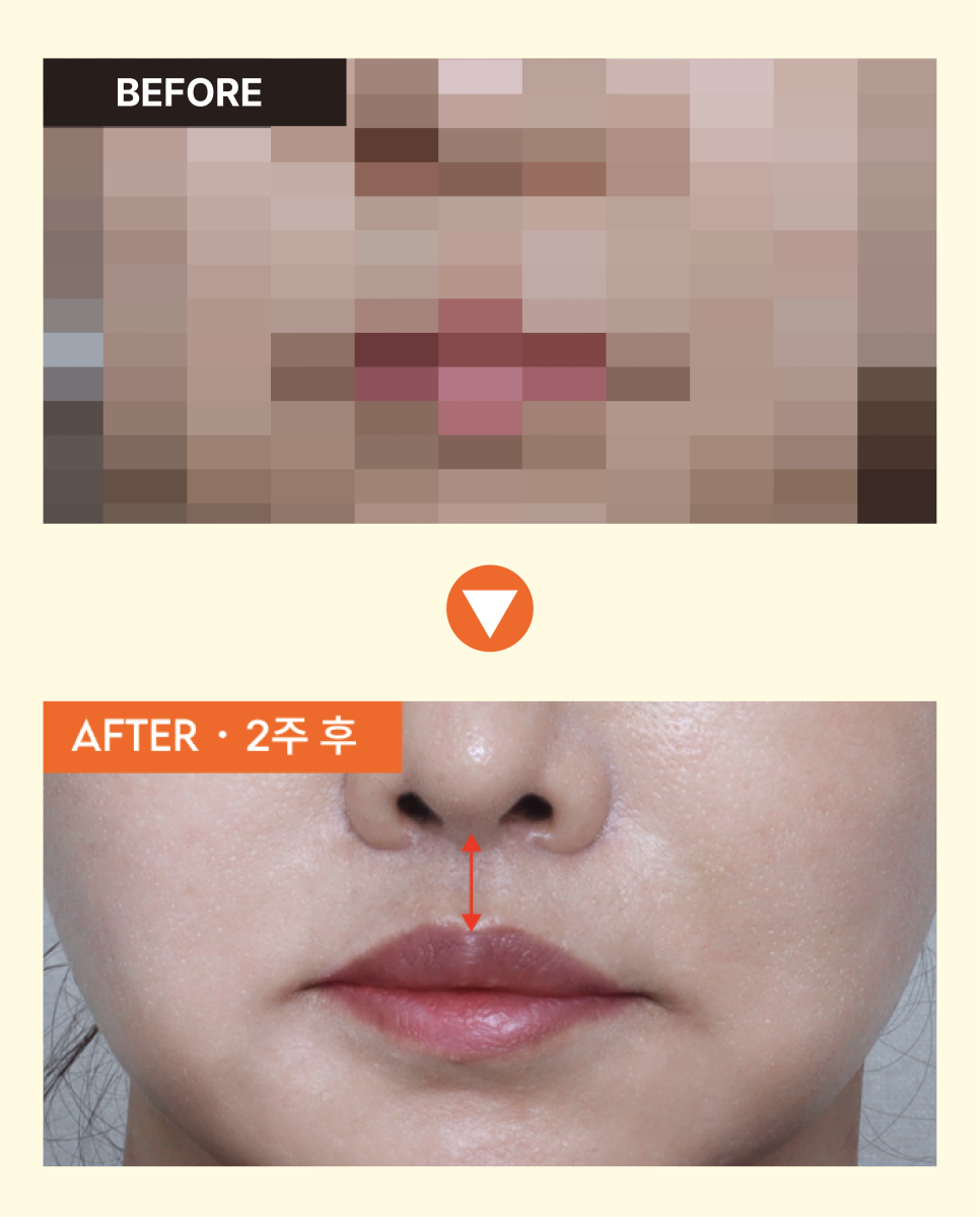 A Review of Upper Lip Reduction Surgery for a Long-Looking Face, and the Aesthetics of Midface Harmony Seen Through Facial Proportions image 9