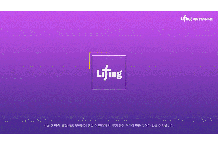Shinsa Mini Lift, Lifting Plastic Surgery Clinic: Clear Answers to Frequently Asked Questions About Smile Lifting! image 1