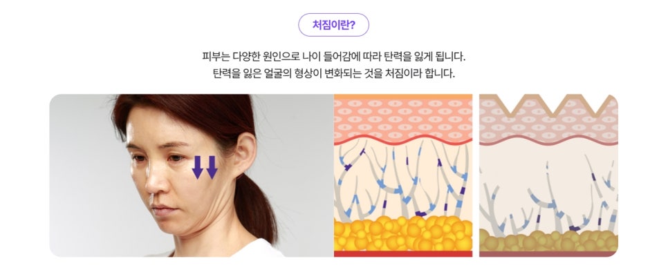 신사, 신사역 성형외과 의사가 밝히는 진정한 리프팅 관련 이미지 2