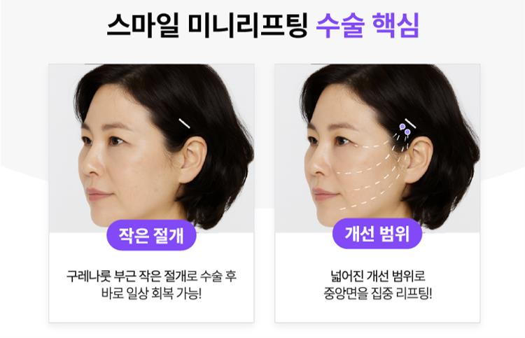 미니리프팅, 여름휴가 전 신사역성형외과에서 알아보는 인상 개선 방법 관련 이미지 8