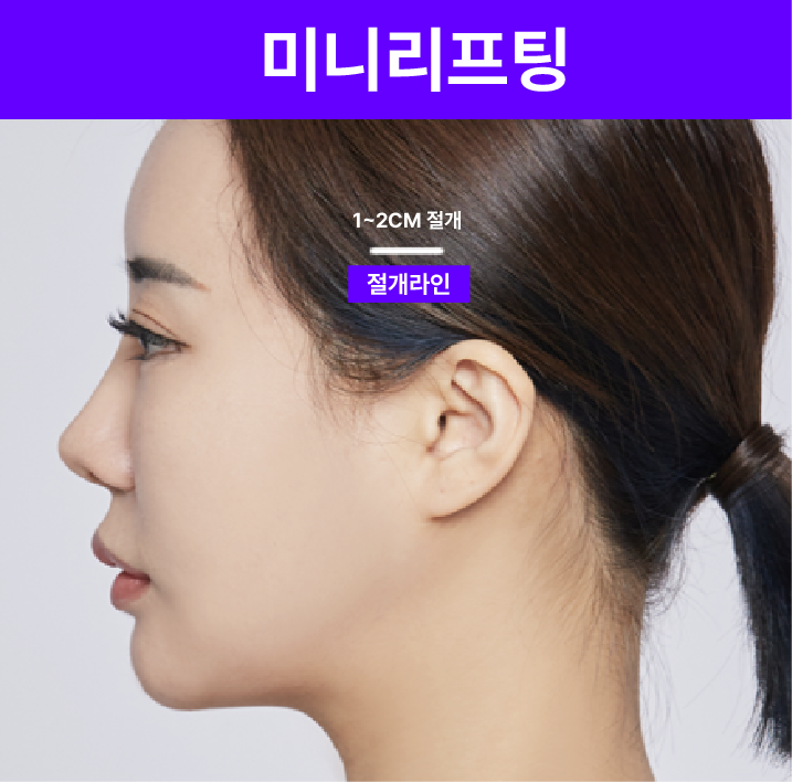 미니리프팅가격, 강남안면거상성형외과에서 보는 겨울 전 탄력 관리의 정밀 설계 관련 이미지 7