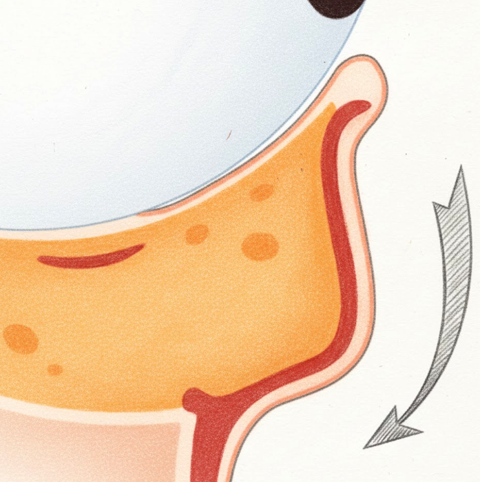 Understanding Gangnam Under-Eye Fat Repositioning, Causes of Hollow Under Eyes, and How the Structure Around the Eyes Changes with Age image 7