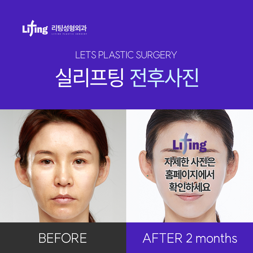 심부볼실리프팅, 효과 제대로 보고 싶다면 10분만 투자하세요 관련 이미지 3