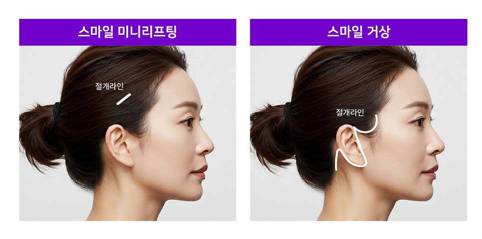 스마일리프팅가격 궁금하다면? 스마일거상과의 차이까지 한번에 정리 관련 이미지 2