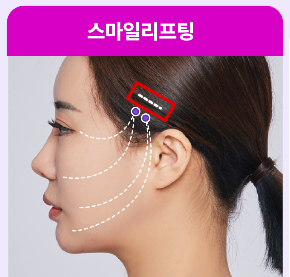 Shinsa Mini Lift, Lifting Plastic Surgery Clinic: Clear Answers to Frequently Asked Questions About Smile Lifting! image 6