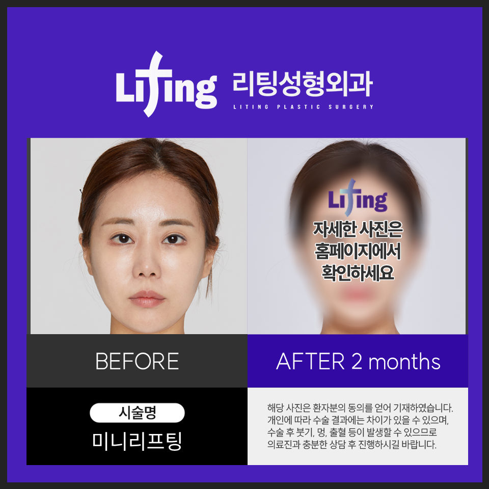 미니안면거상술 핵심? 현직 의사가 답해드립니다 관련 이미지 4