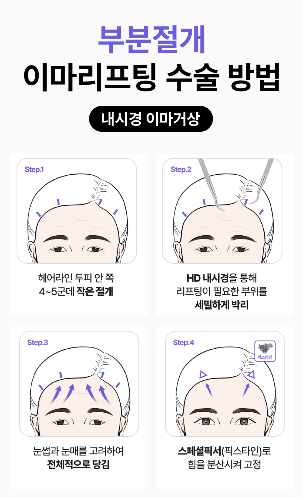 광주성형외과 이마리프팅으로 동안 인상되찾기 관련 이미지 9